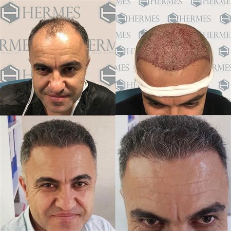 hermes hair clinic saç ekim fiyatları|saç ekimi istanbul.